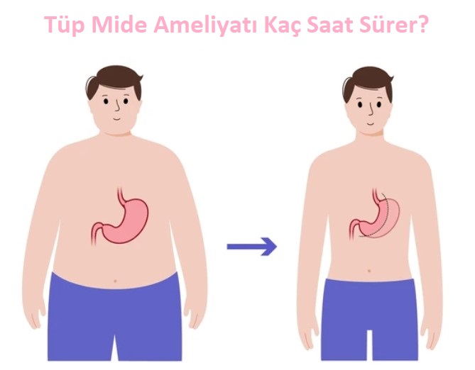 Tüp Mide Ameliyatı Kilo Verme Sürecini Hızlandırıyor